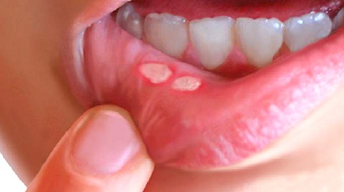 Comment soigner un aphte naturellement ?